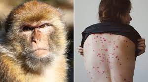 Confirmaron el primer caso de viruela del mono en Mendoza y es el cuarto en todo el país